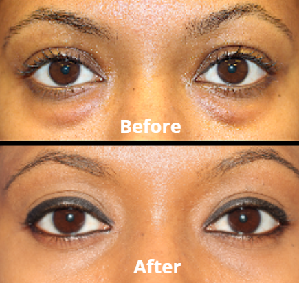 Peptide Collagen Hydrogel Eye Patch